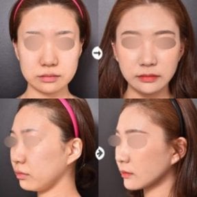 Vorher-nachher-Ergebnis der Gesichtsfetttransplantation bei VG Plastic Surgery, mehr Volumen