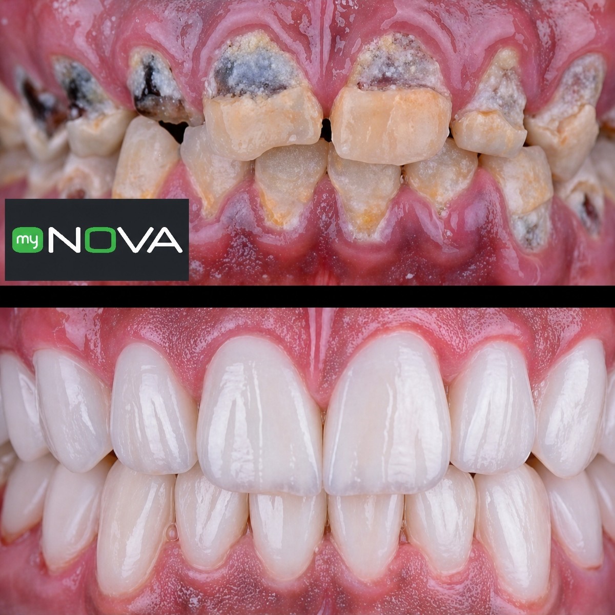 Resultados antes y después de implantes All-on-6 en My Nova Kusadasi Dental Clinic, sonrisa restaurada