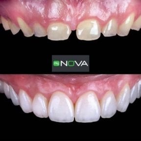 Before and after All-on-6 dental implants result at My Nova Kusadasi Dental Clinic, smile restored