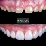 Before and after All-on-6 dental implants result at My Nova Kusadasi Dental Clinic, smile restored