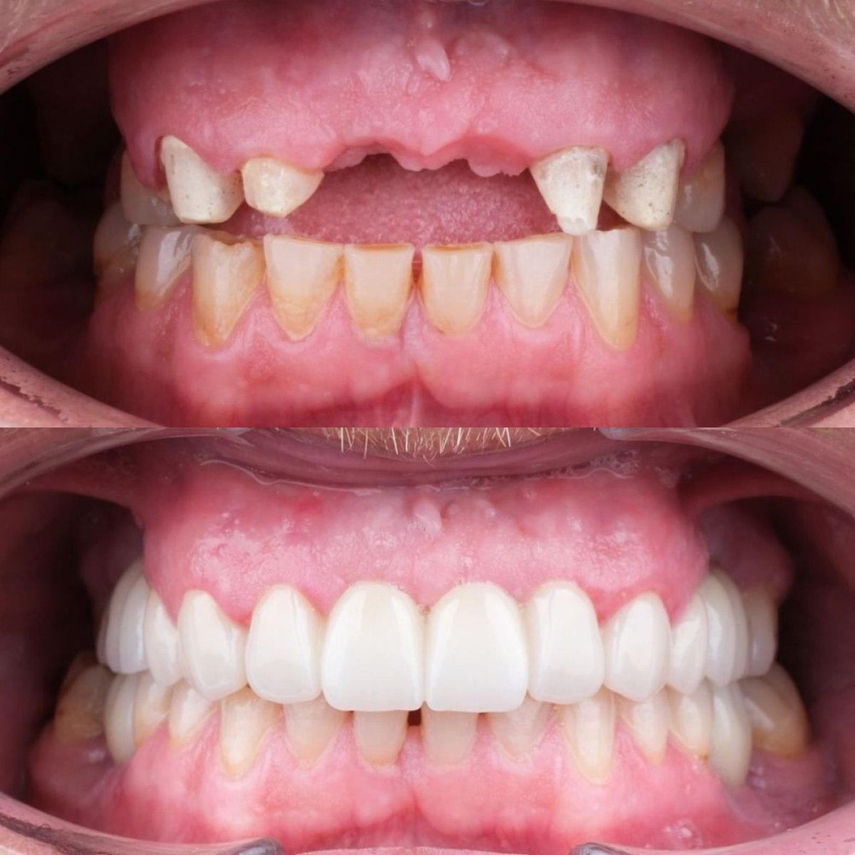Resultados antes y después de implantes All-on-6 en My Nova Kusadasi Dental Clinic, sonrisa restaurada