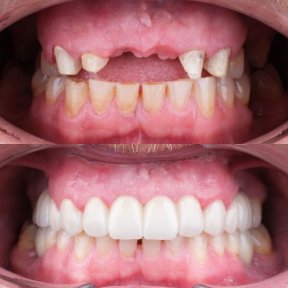 Before and after All-on-6 dental implants result at My Nova Kusadasi Dental Clinic, smile restored