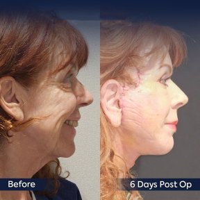 Forehead lift before and after results at Dr. Safa Manav Clinic, visible facial rejuvenation