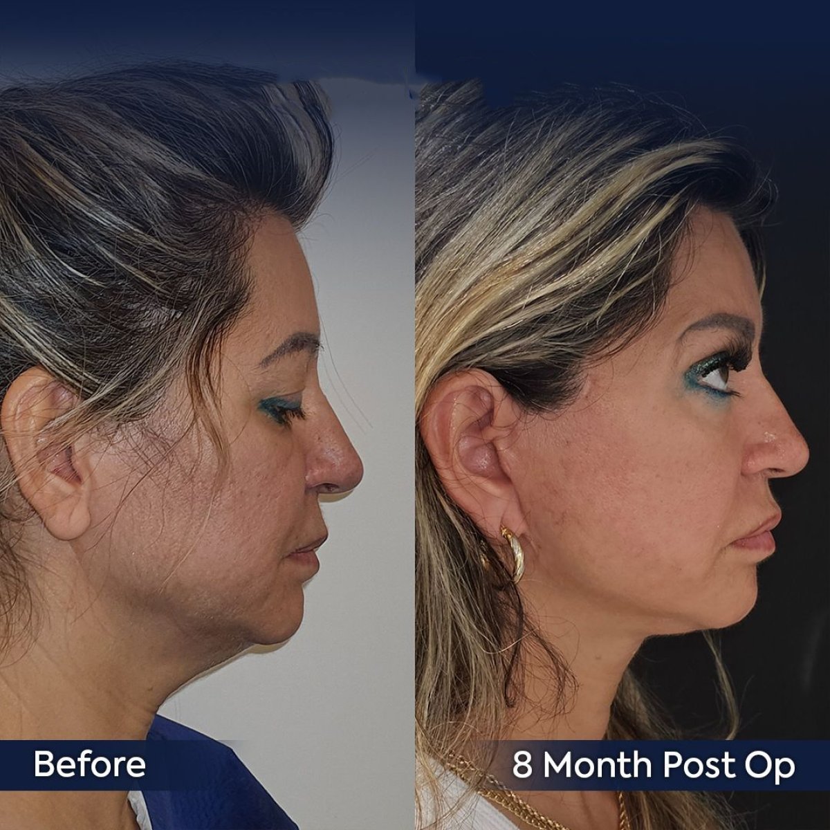 Resultados de lifting de frente antes y después en Dr. Safa Manav Clinic, rejuvenecimiento facial