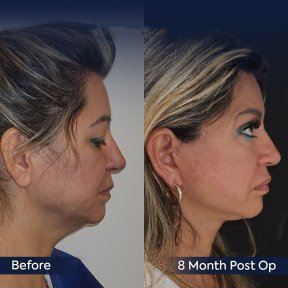 Forehead lift before and after results at Dr. Safa Manav Clinic, visible facial rejuvenation