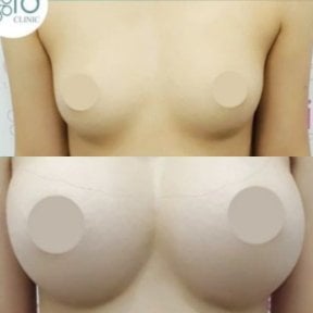 Before and after breast implants with lift at ID Clinic Bangkok, enhanced breast shape result