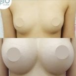 Before and after breast implants with lift at ID Clinic Bangkok, enhanced breast shape result