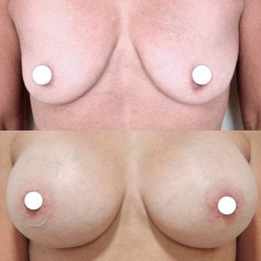 Before and after breast implants with lift results at ID Clinic Bangkok, enhanced breast shape