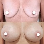 Before and after breast implants with lift results at ID Clinic Bangkok, enhanced breast shape
