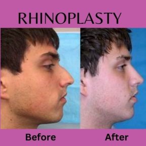 Before and after rhinoplasty results at ID Clinic Bangkok, improved nose shape and profile