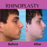 Before and after rhinoplasty results at ID Clinic Bangkok, improved nose shape and profile