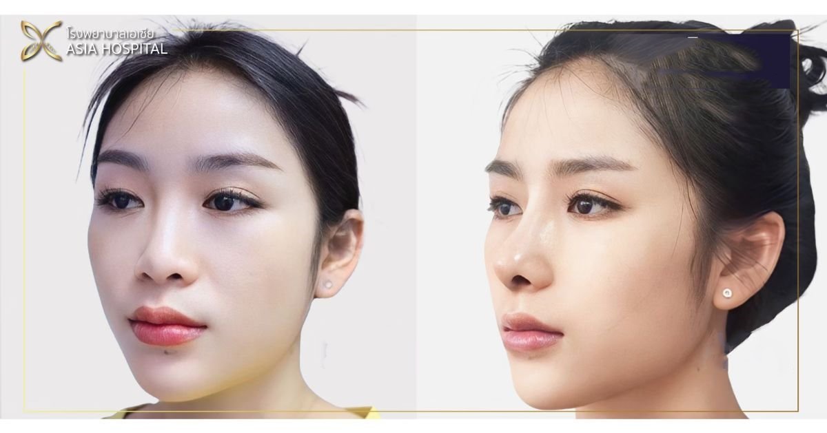 Resultados antes y después de rinoplastia de revisión en Asia Cosmetic Hospital, contorno mejorado