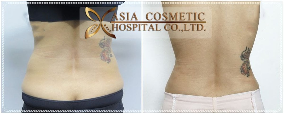 نتائج شفط الدهون قبل وبعد في Asia Cosmetic Hospital، تحسين واضح لمحيط الخصر