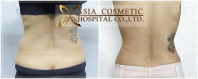 Результаты липосакции до и после в Asia Cosmetic Hospital, улучшение контура талии