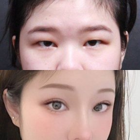 Before and after droopy eyelid surgery results at VG Plastic Surgery, improved eye appearance