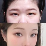 Before and after droopy eyelid surgery results at VG Plastic Surgery, improved eye appearance