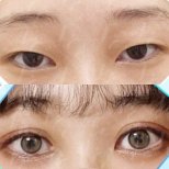 Before and after droopy eyelid surgery results at VG Plastic Surgery, improved eye appearance