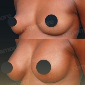 Before and after breast implant revision results at Memorial Şişli Hospital, improved shape