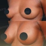 Before and after breast implant revision results at Memorial Şişli Hospital, improved shape