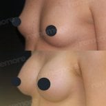 Before and after breast implant revision at Memorial Şişli Hospital, improved breast shape result
