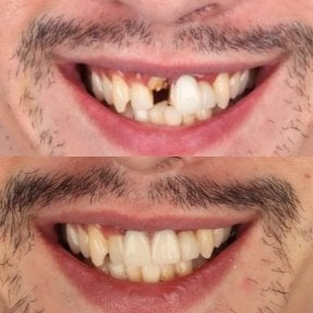 Before and after dental implant results at SmileBox Dental Clinic - Thonglor, improved smile