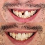Before and after dental implant results at SmileBox Dental Clinic - Thonglor, improved smile