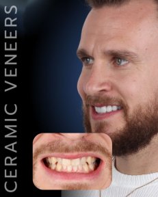 Vorher-nachher-Ergebnis Keramikveneers bei SmileBox Dental Clinic - Thonglor, Sukhumvit