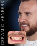 Vorher-nachher-Ergebnis Keramikveneers bei SmileBox Dental Clinic - Thonglor, Sukhumvit
