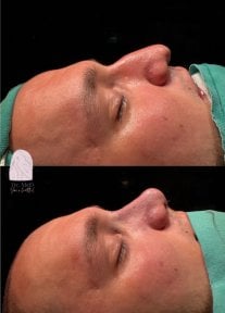 Before and after rhinoplasty result at Dr. MED, improved nose shape and profile in male patient