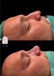 Before and after rhinoplasty result at Dr. MED, improved nose shape and profile in male patient