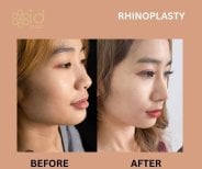 Before and after revision rhinoplasty results at ID Clinic Bangkok, improved nose shape
