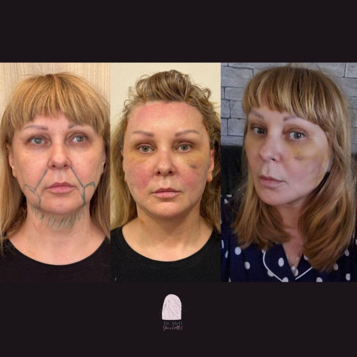 Resultados antes y después de lifting de cuello en Dr. MED – mejora del contorno facial
