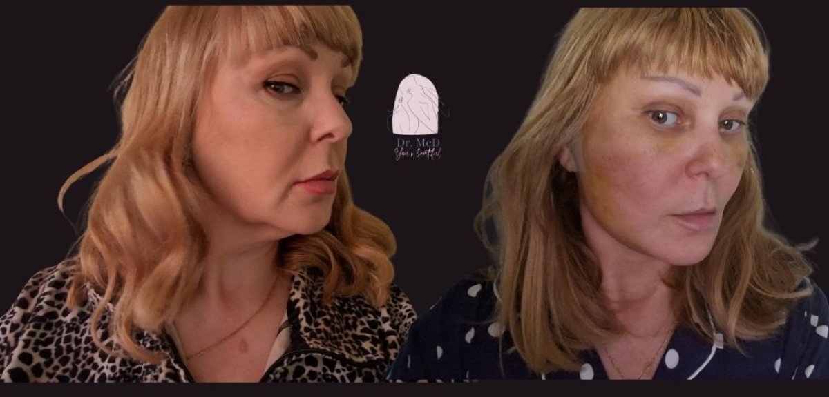 Resultados antes y después de lifting de cuello en Dr. MED, mejora visible de mandíbula y cuello