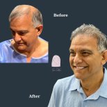 نتائج زراعة الشعر قبل وبعد في Dr. MED – استعادة خط الشعر وكثافة أعلى