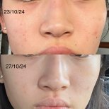 Before and after stem cell rejuvenation therapy at EDNA Wellness, visible skin clarity result