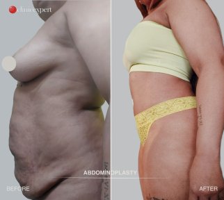 Before and after tummy tuck results at CE International Hospital, visible abdominal contouring