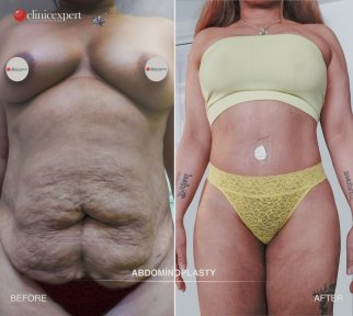 Before and after tummy tuck results at CE International Hospital, improved abdominal contour