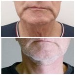 Before and after neck lift results at Asia Cosmetic Hospital, improved neck contour visible