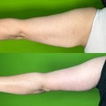 Résultats avant et après liposuccion des bras à la clinique Prof. Furkan Karabekmez