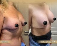 Before and after breast lift results at Dr. Safa Manav Clinic, 3 months post-op improvement