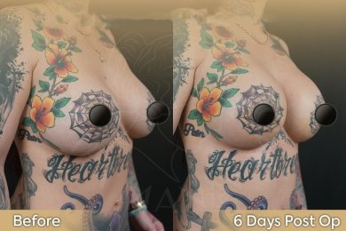 Результати до і після підтяжки грудей у клініці Dr. Safa Manav, помітний ліфтинг і контур