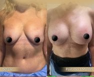 Before and after breast lift results at Dr. Safa Manav Clinic, 3 months post-op improvement