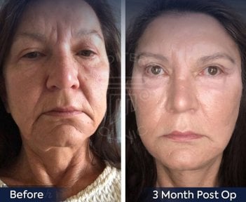 Resultados de lifting facial antes y después en Dr. Safa Manav Clinic, 3 meses postoperatorio