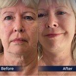 Facelift Vorher-Nachher-Ergebnisse in der Dr. Safa Manav Klinik, sichtbare Verjüngung