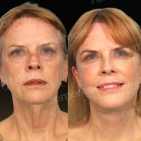 Facial fat transfer before and after results at Memorial Antalya Hospital, rejuvenated appearance