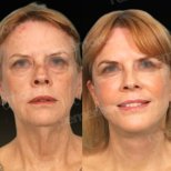 Facial fat transfer before and after results at Memorial Antalya Hospital, rejuvenated appearance