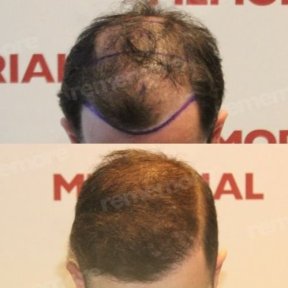Before and after FUE hair transplant results at Memorial Antalya Hospital, restored hairline