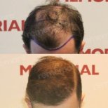 Before and after FUE hair transplant results at Memorial Antalya Hospital, restored hairline