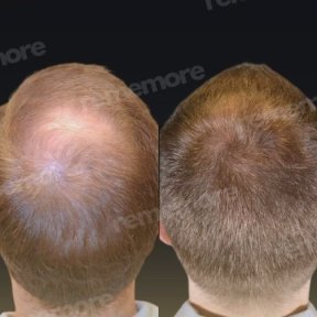 Before and after FUE hair transplant results at Memorial Antalya Hospital, improved hair density