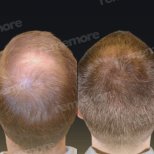 Before and after FUE hair transplant results at Memorial Antalya Hospital, improved hair density